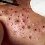 Blackhead Best Video #23