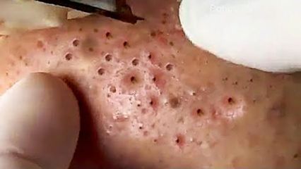 Blackhead Best Video #23