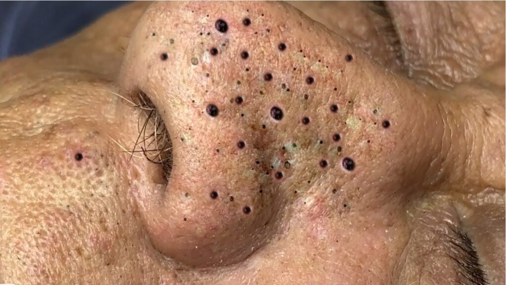 Blackhead Best Video #60