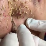 Blackhead Best Video #46