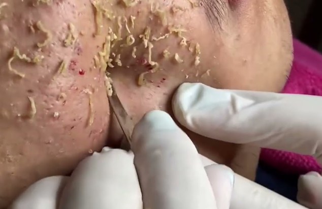 Blackhead Best Video #46