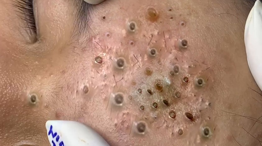 Blackhead Best Video #48