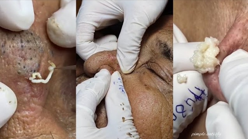 Blackhead Best Video #93