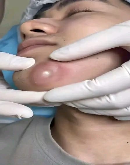 Blackhead Best Video #54