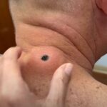 Blackhead Best Video #63