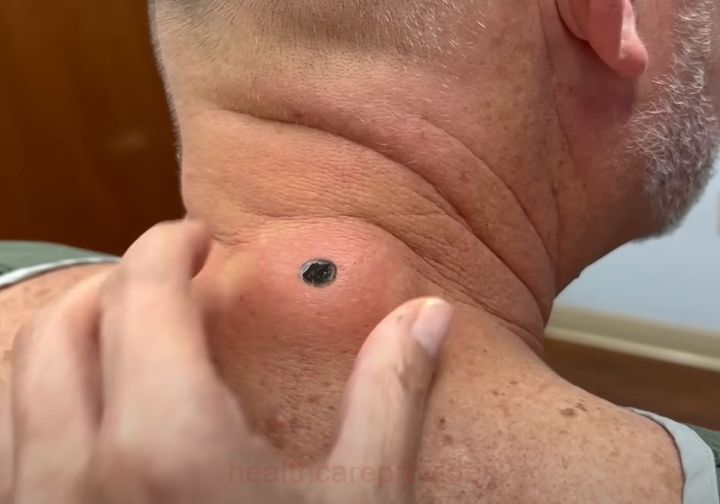 Blackhead Best Video #63