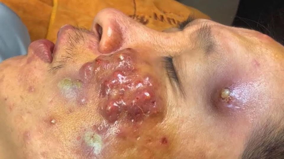 Blackhead Best Video #82