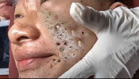 Blackhead Best Video #141