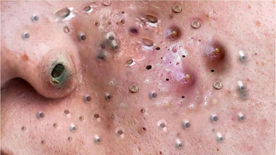 Blackhead Best Video #156