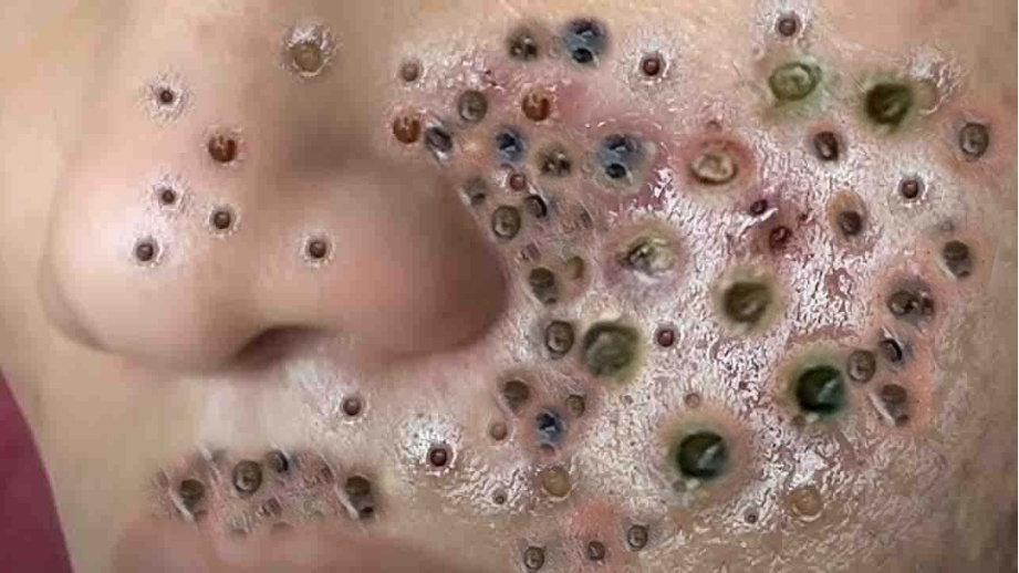 Blackhead Best Video #170