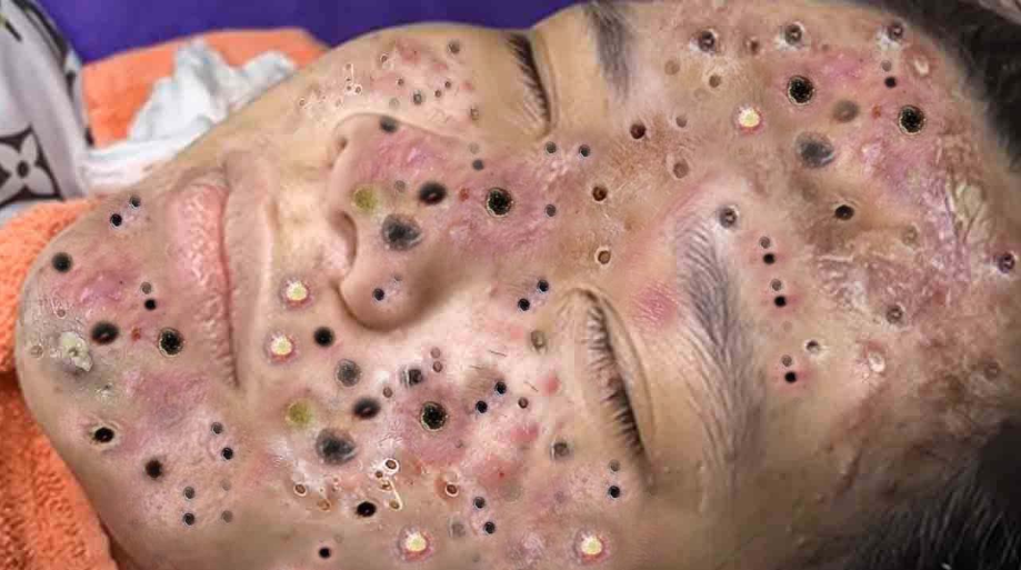 Blackhead Best Video #172