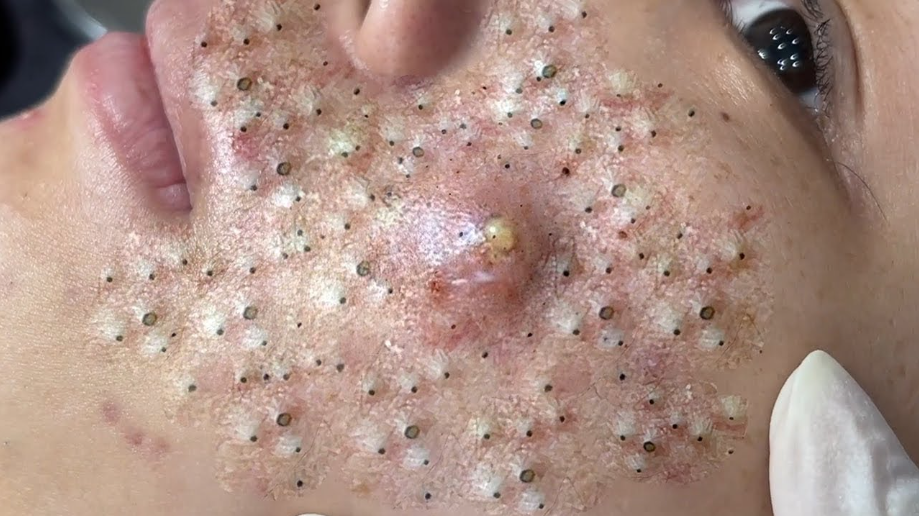 Blackhead Best Video #177